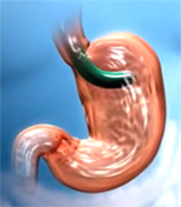 Endoscopic stomach reduction