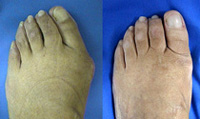 Bunion before and after surgery