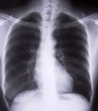 Chest X-ray
