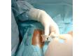 Teknon successfully combats osteoarthritis with cell therapy